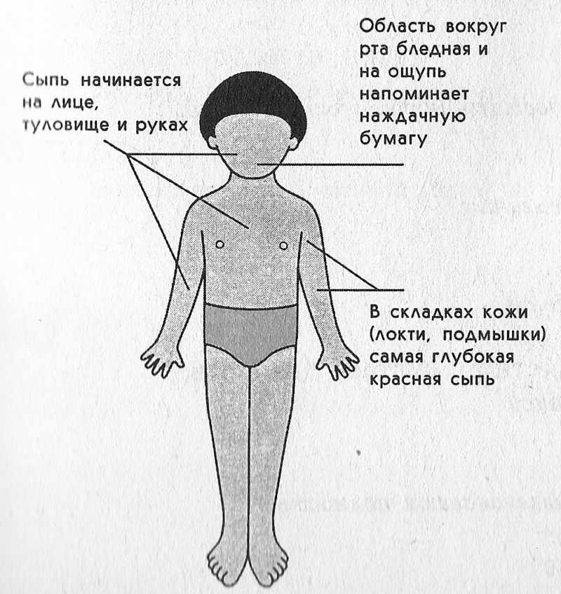 Появление сыпи при краснухе