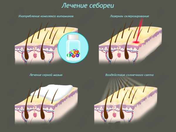 Лечение себореи