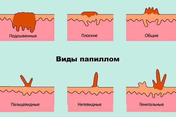 Виды папиллом