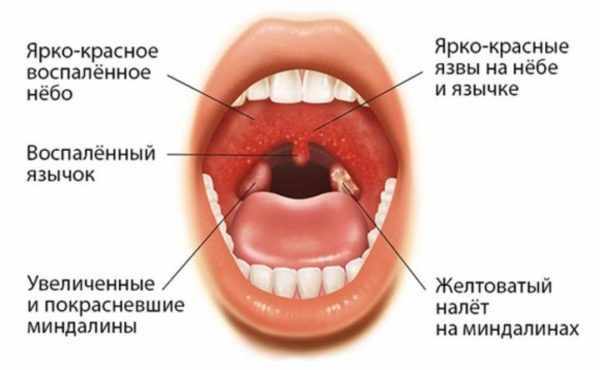 Герпетическая ангина при вирусе Коксаки