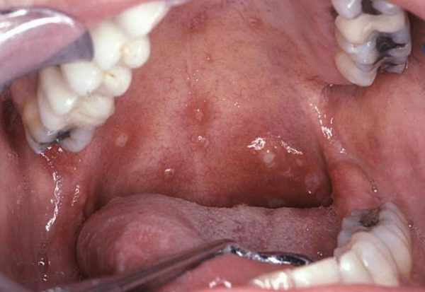 Герпес в ротовой полости