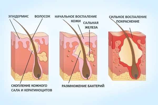 Стадии развития фурункула
