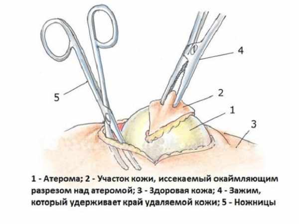 Удаление атеромы хирургическим путем