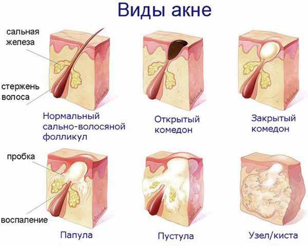 Виды акне