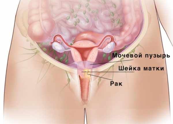 Рак шейки матки
