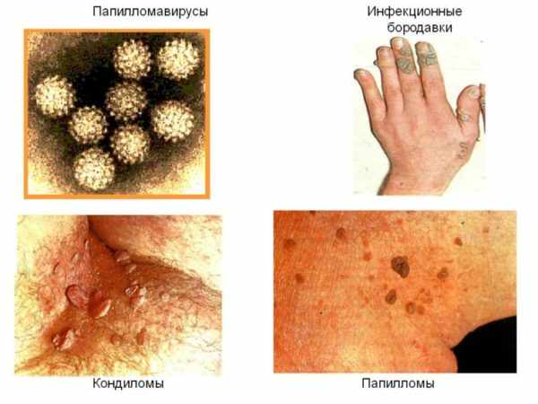 Папилломы, кондиломы, бородавки