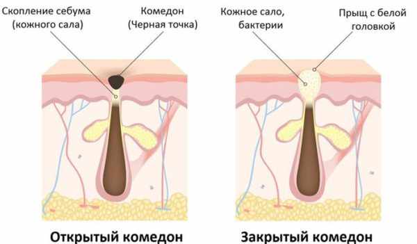 Этиология и патогенез комедонов на лице