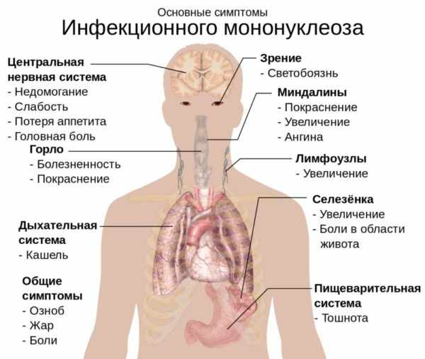 Инфекционный мононуклеоз