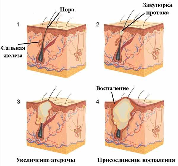 Формирование атеромы