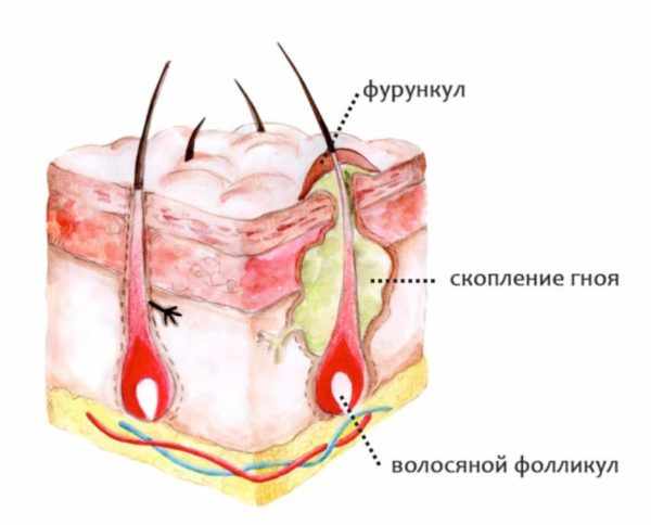 Фурункул