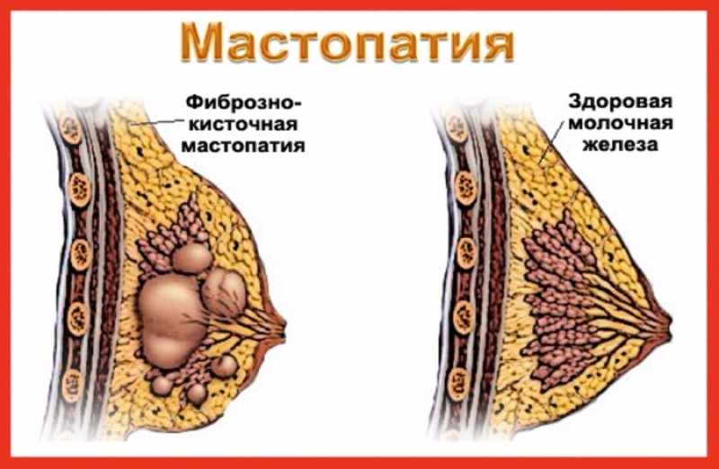 Мастопатия