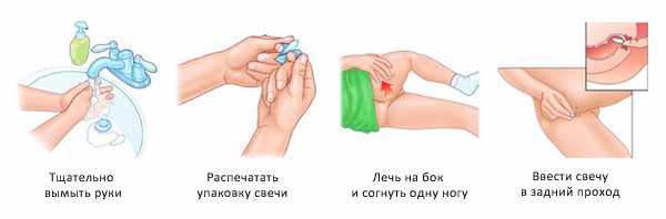 Правильное введение суппозитория