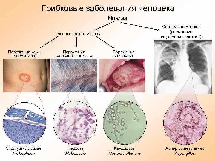 Грибок внутренних органов