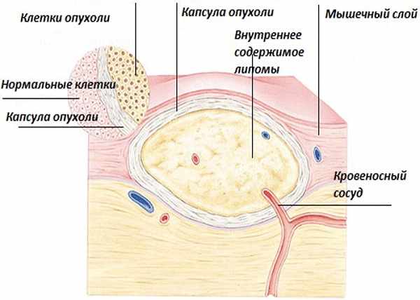 Образование липомы