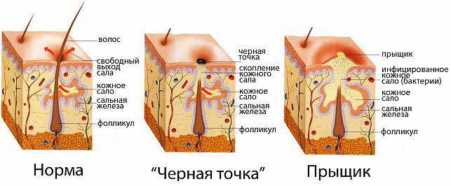 Прыщи