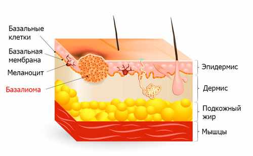 Схематическое изображение базалиомы