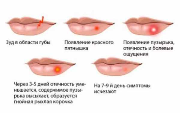 Этапы герпетической сыпи