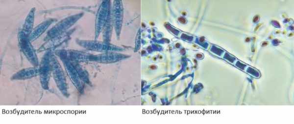 Отличие трихофитии от микроспории