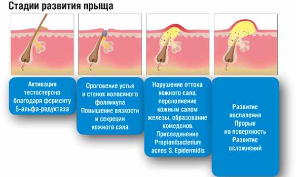 Стадии развития акне