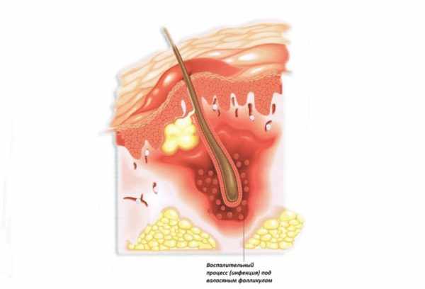 Схема образования фурункула