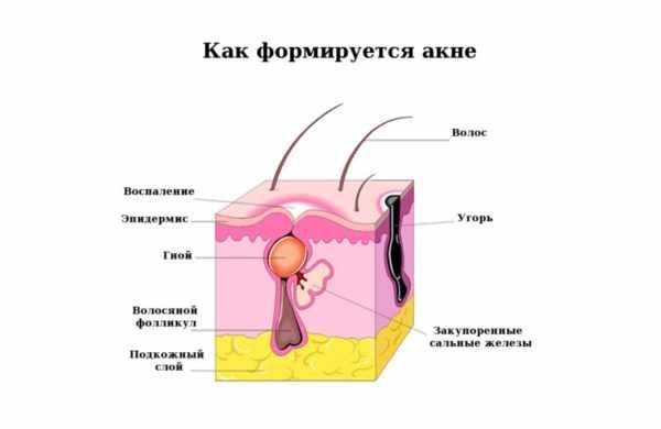 Механизм развития акне