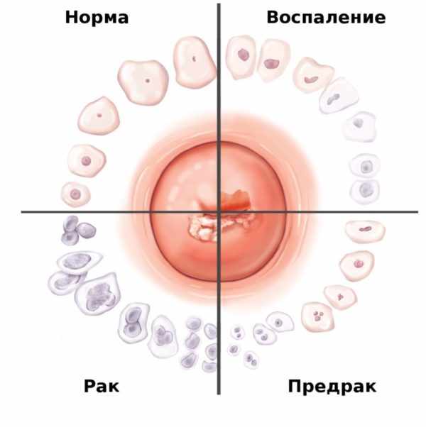 Переход кондиломы в карциому