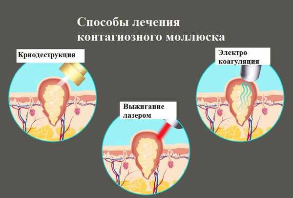 Лечение контагиозного моллюска