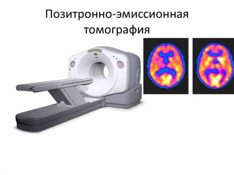 Позитронно-эмиссионная томография