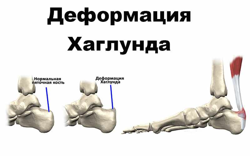 Пятки при деформации Хаглунда