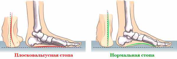 Вальгусная стопа