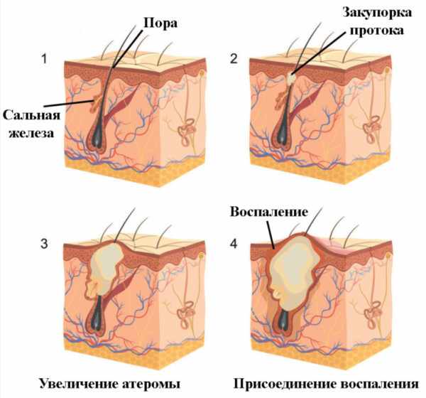 Развитие липомы