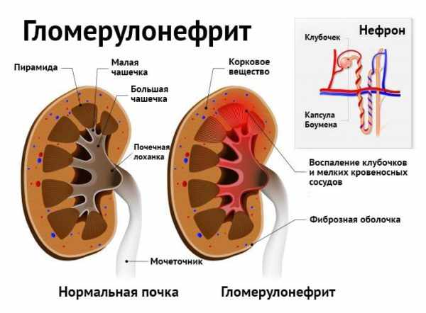 Гламерулонефрит