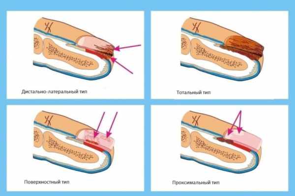 Виды онихомикозов