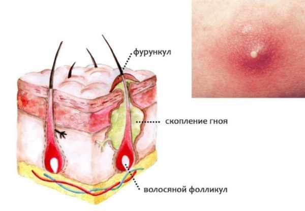 Фурункул