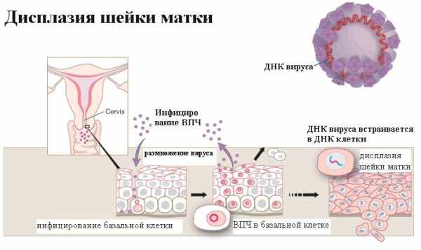 Дисплазия шейки матки 