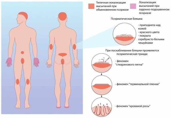 Типичная локализация высыпаний при псориазе