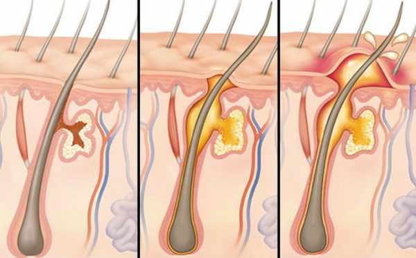 Стадии развития фурункулов