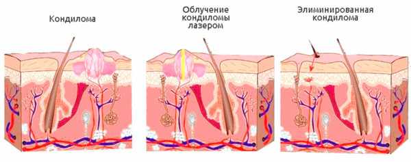 Удаление кондилом лазером