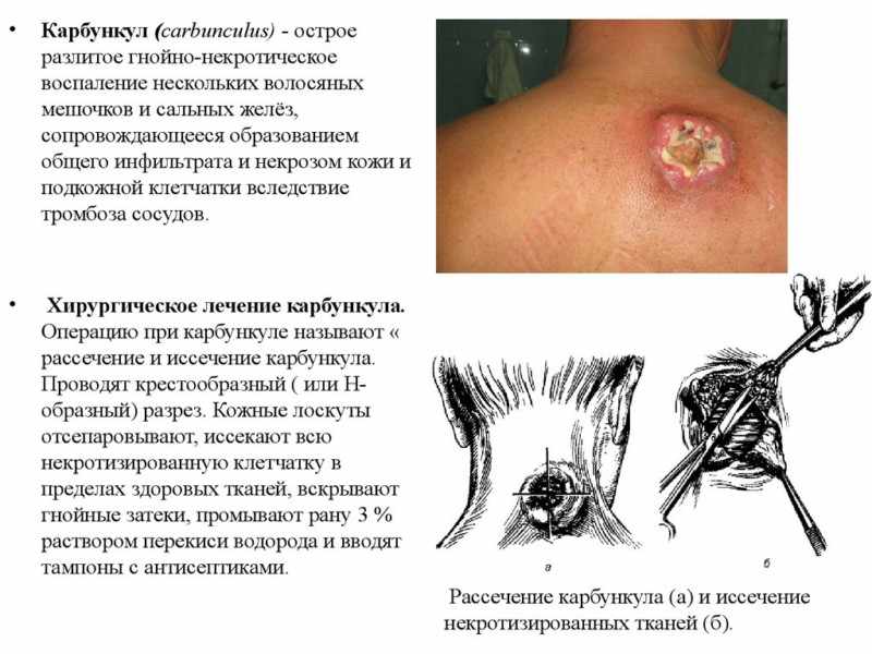 лечение карбункула