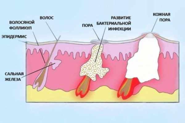 Стадии созревания фурункула