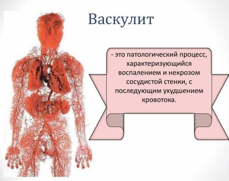 Васкулит