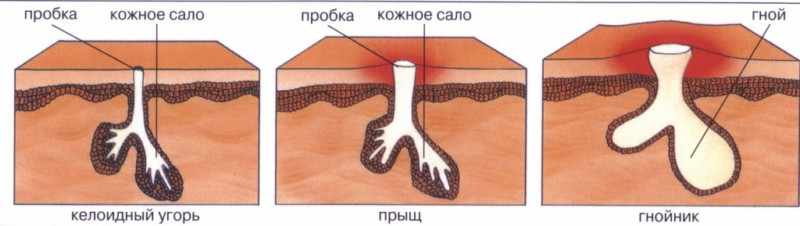 Причины фурункула