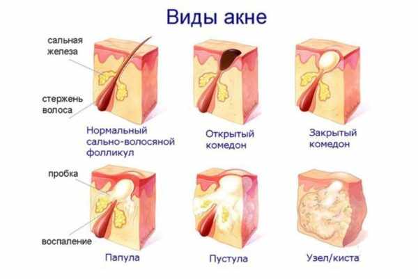 Виды угревых образований