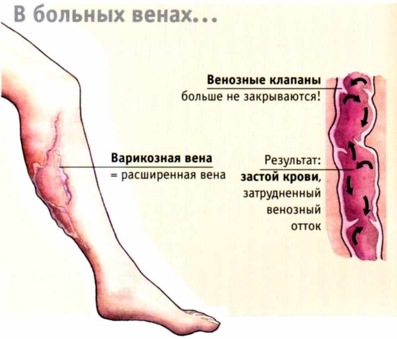 Варикозное расширение вен