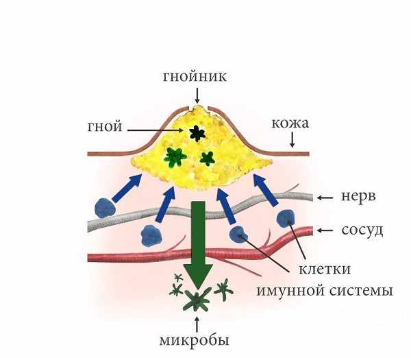 Схема образования гнойничка