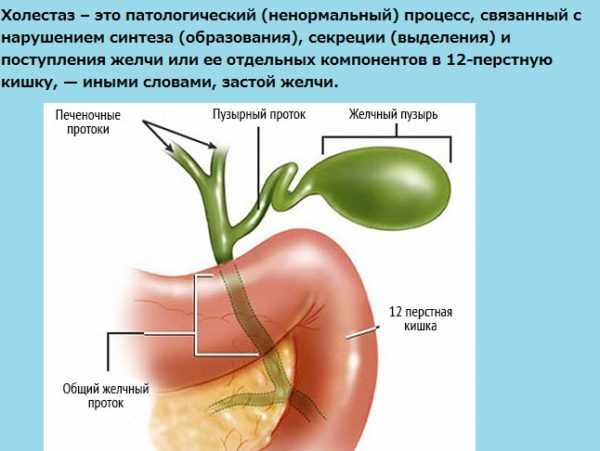 Холестаз