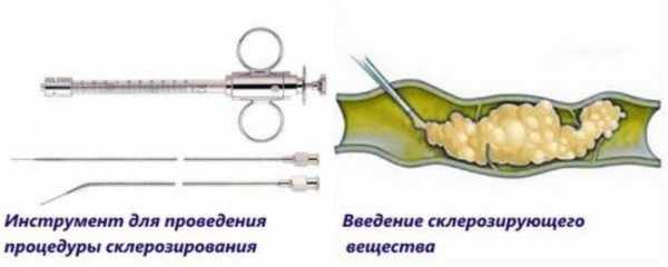 Склерозирование гемангиомы