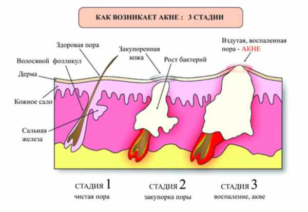 Механизм развития акне