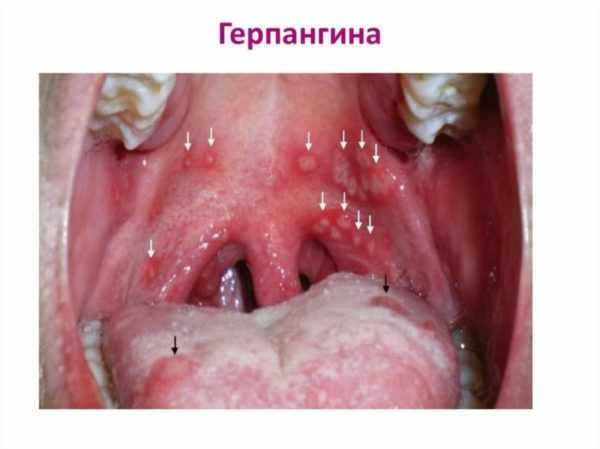 Герпесная ангина