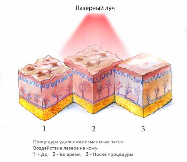 Удаление пигментных пятен лазером